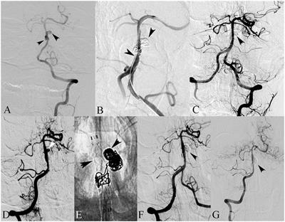 Risk Factors of Recurrence after Stent(s)-Assisted Coiling of Intracranial Vertebrobasilar Dissecting Aneurysms: A Multicenter Study